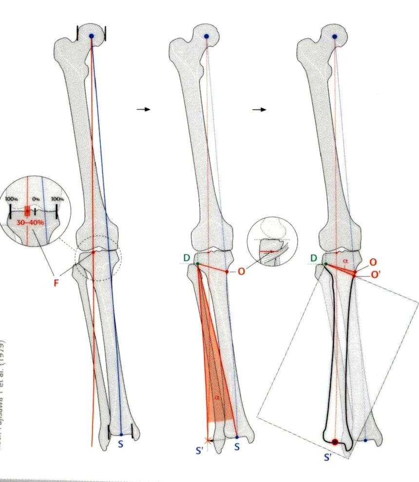 X und OBein Fehlstellungen Beinachsenkorrektur Hüfte & Knie Orthozentrum Cham, Zug